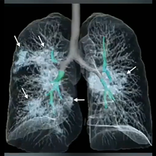 肺のCT画像のコピー